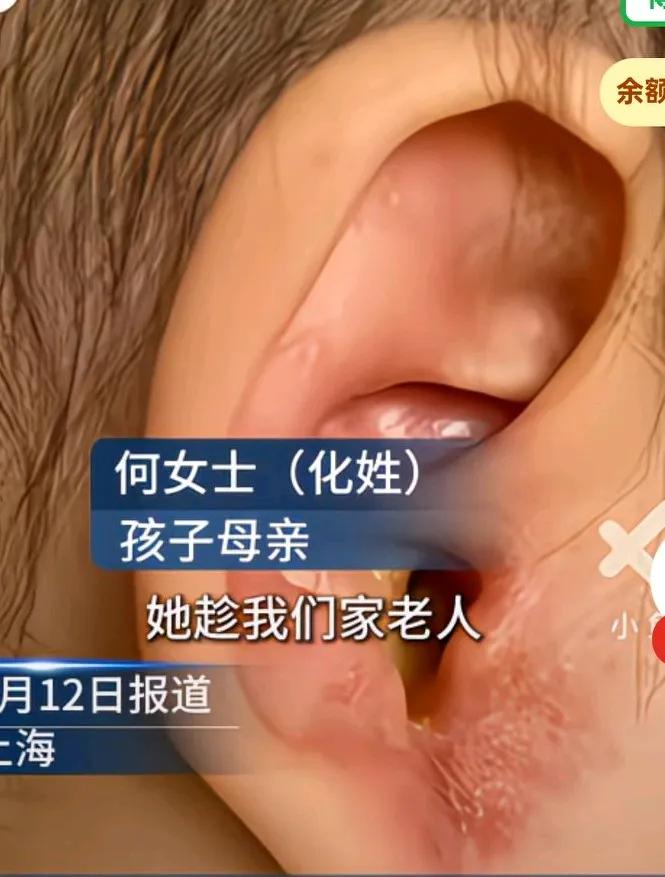 住家保姆过失致孩子鼓膜破裂，孩子年龄太小无法进行司法鉴定，女子说住家保姆用棉签
