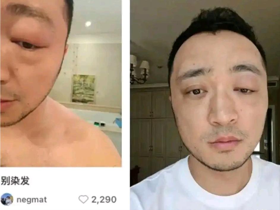 别染发！别染发！！4月15日，著名主持人尼格买提晒出了一张照片，他的眼睛肿的非