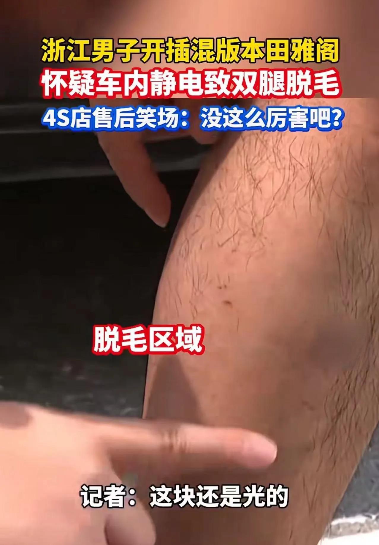 浙江绍兴，男子怀疑汽车静电导致双腿脱毛，去4S店讨说法时，售后主管忍不住笑场：“