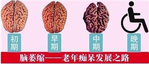 脑萎缩早期治疗尤其关键