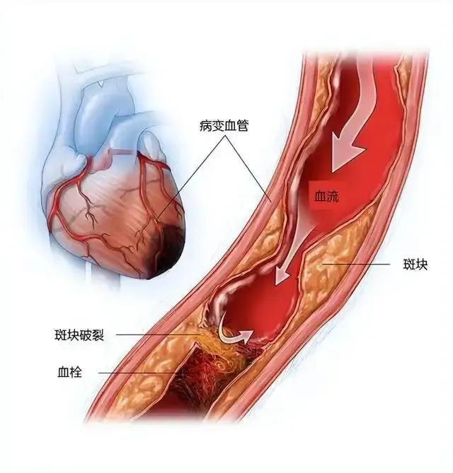 说颈动脉低回声斑块比高回声斑块危险、严重很荒唐！其实，每个斑块都是从低回声演进为
