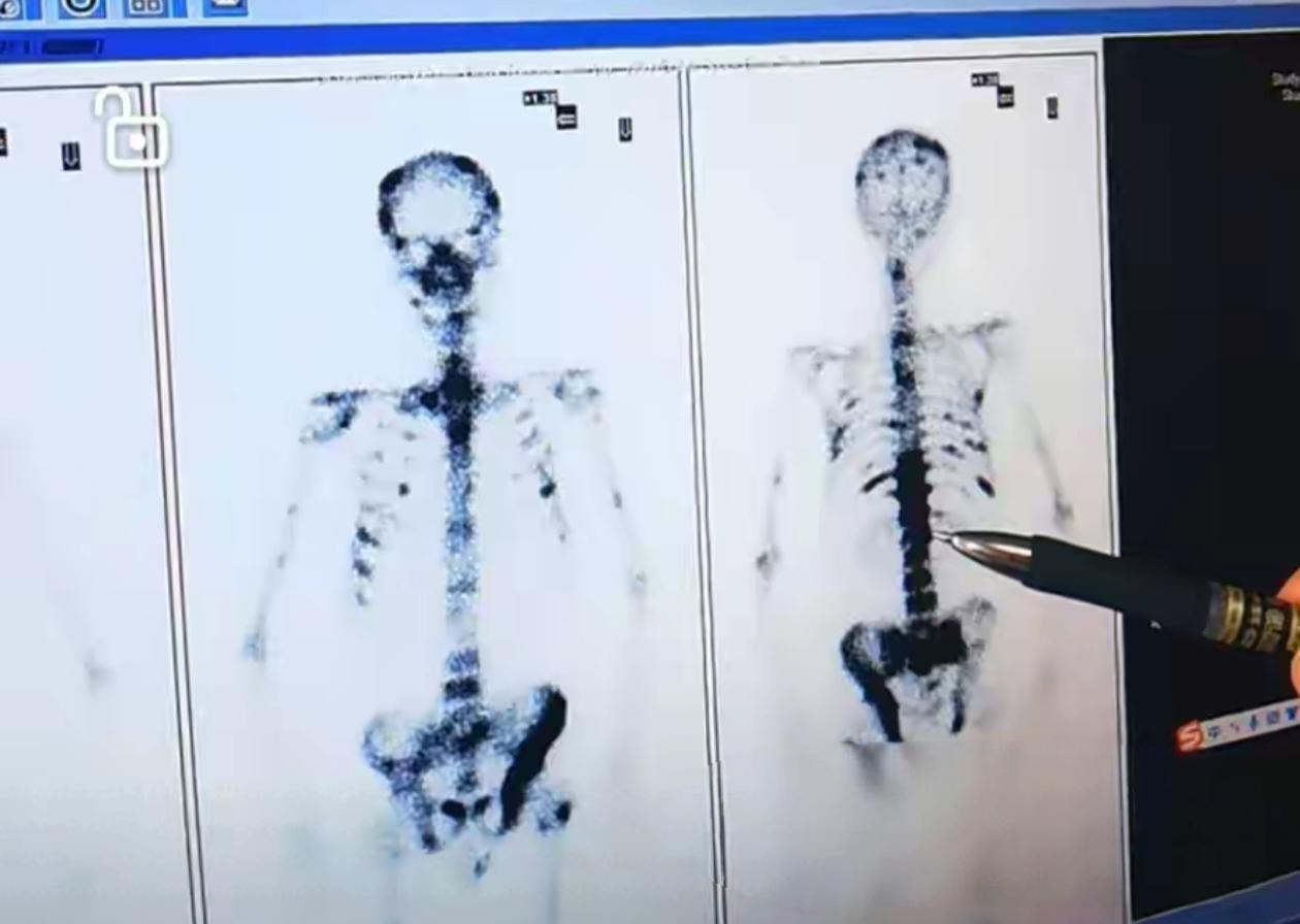 82岁的王某（化名）因血尿、尿频尿急就诊福州大学附属省立医院，影像学检查显示其体