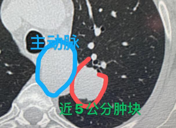 一位62岁的云南老人，最近咳嗽的时候，发现痰里带血，心里一下子就慌了，赶紧去医院