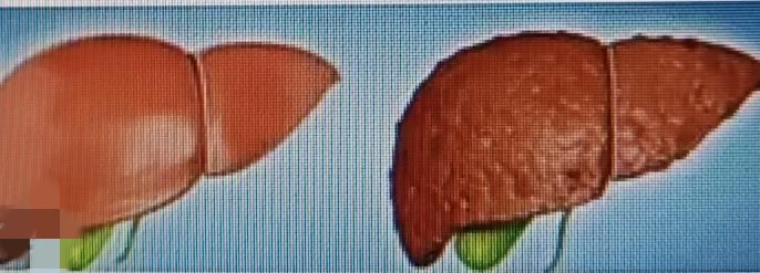 乙肝携带者一生不发病率有多少?乙肝携带者一生不发病的概率挺高，约为80%-