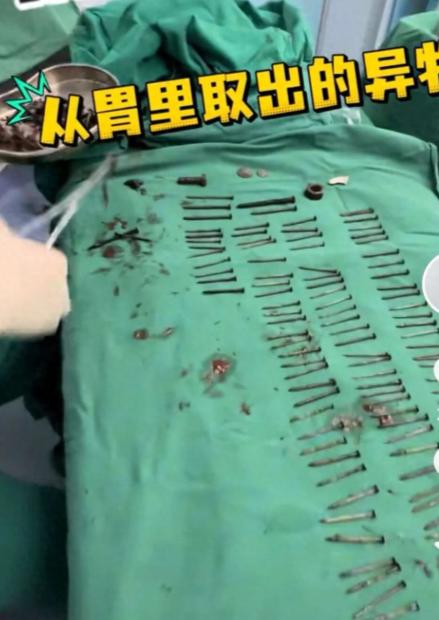 太惊人了！8月10日第一现场报道，云南，一中年男子因为反复呕吐腹痛被送医，CT影