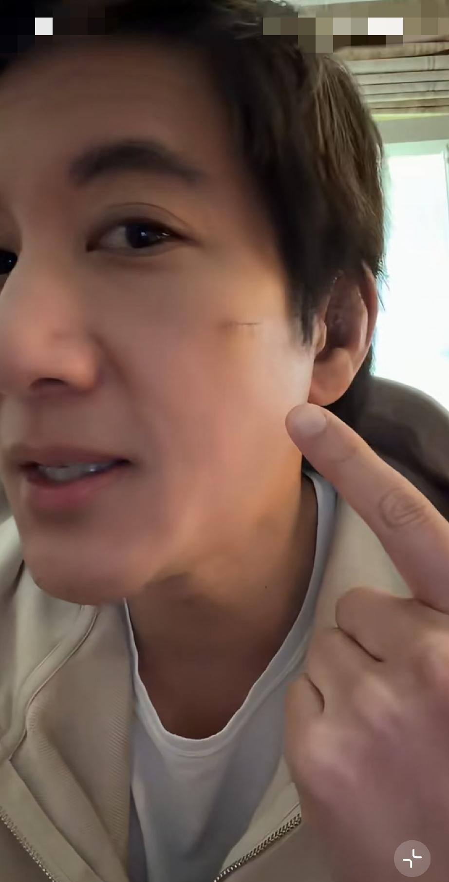 7月12日，王力宏更新视频晒伤口全新照片，脸上的那道疤已经快长好了，可以拆线了，