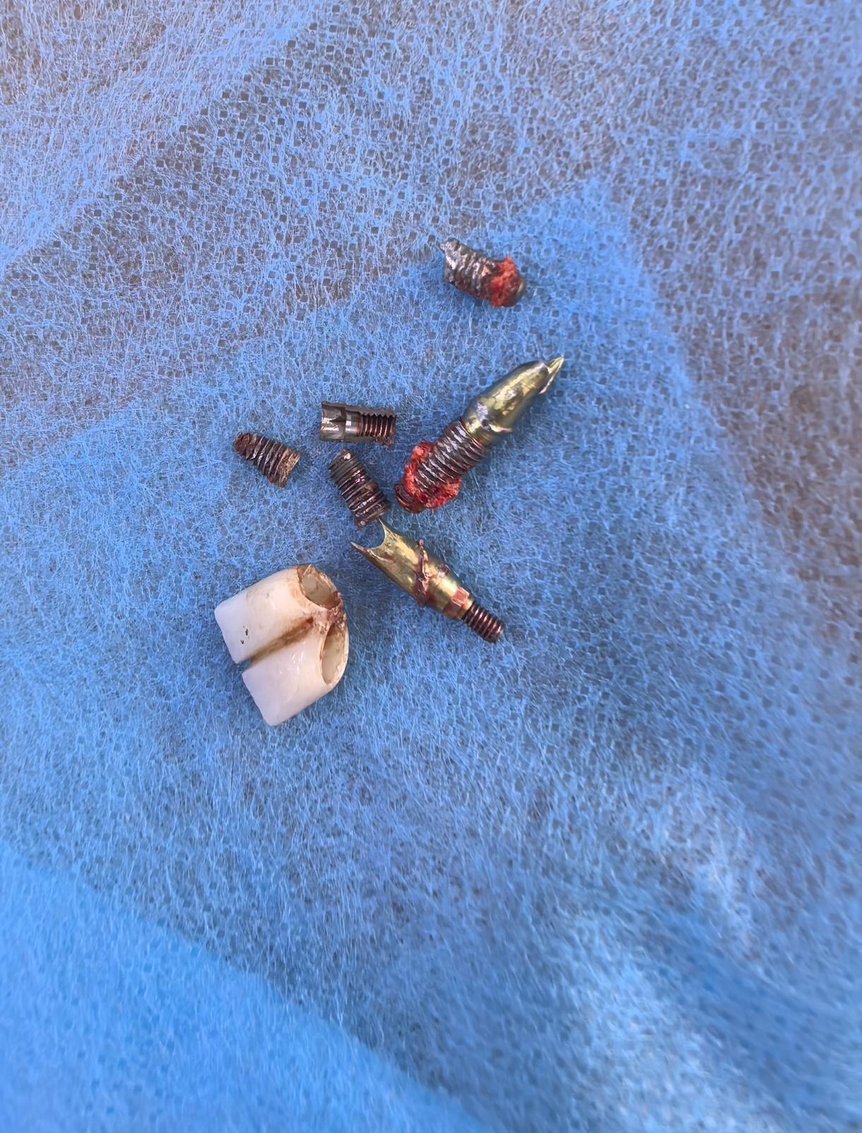 看到这几个钢钉，就觉得很疼，大家得好好保护牙齿了。种牙前多方面评估，例如骨头不够