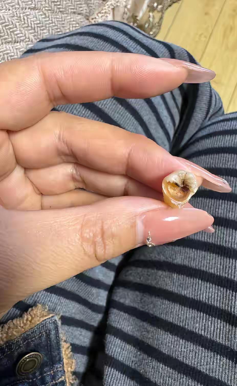 终于拔掉了这个尽头牙了。去年痛了一次，吃了点药后一直没痛过，这两个月准备来例