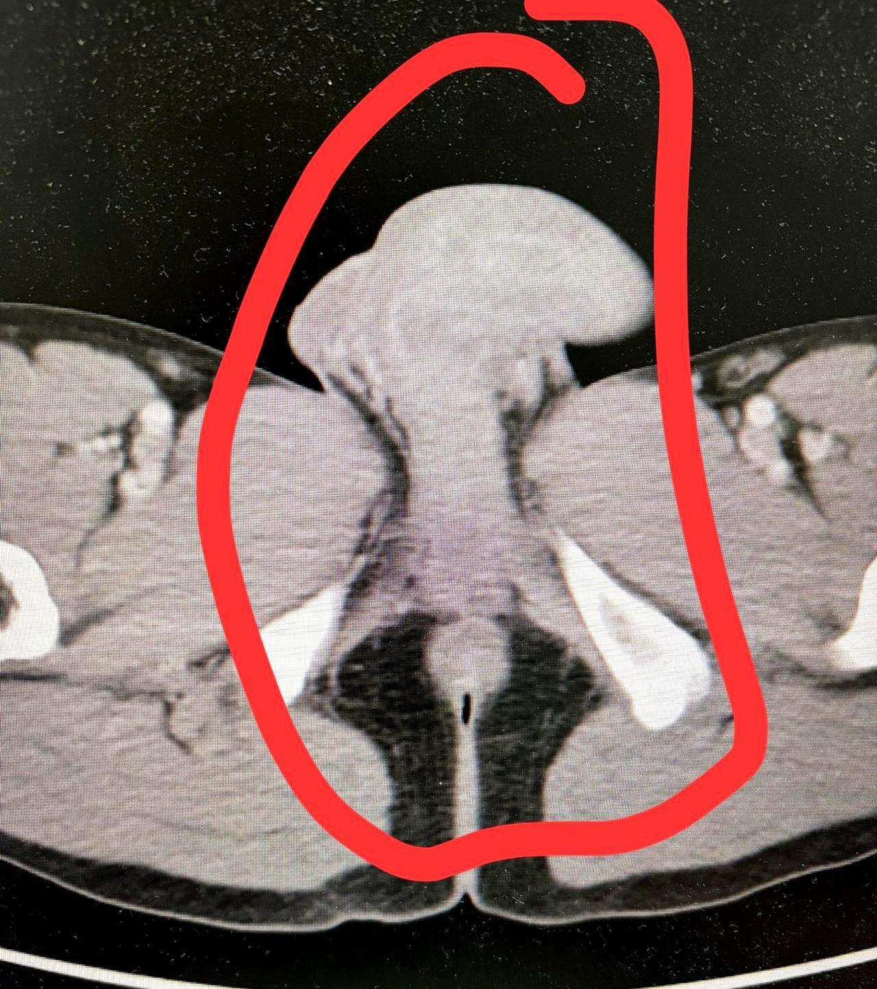 大年初二的急诊，比预想的忙。32岁男子被扶进来，脸色发白，只说是肚子疼。问吃