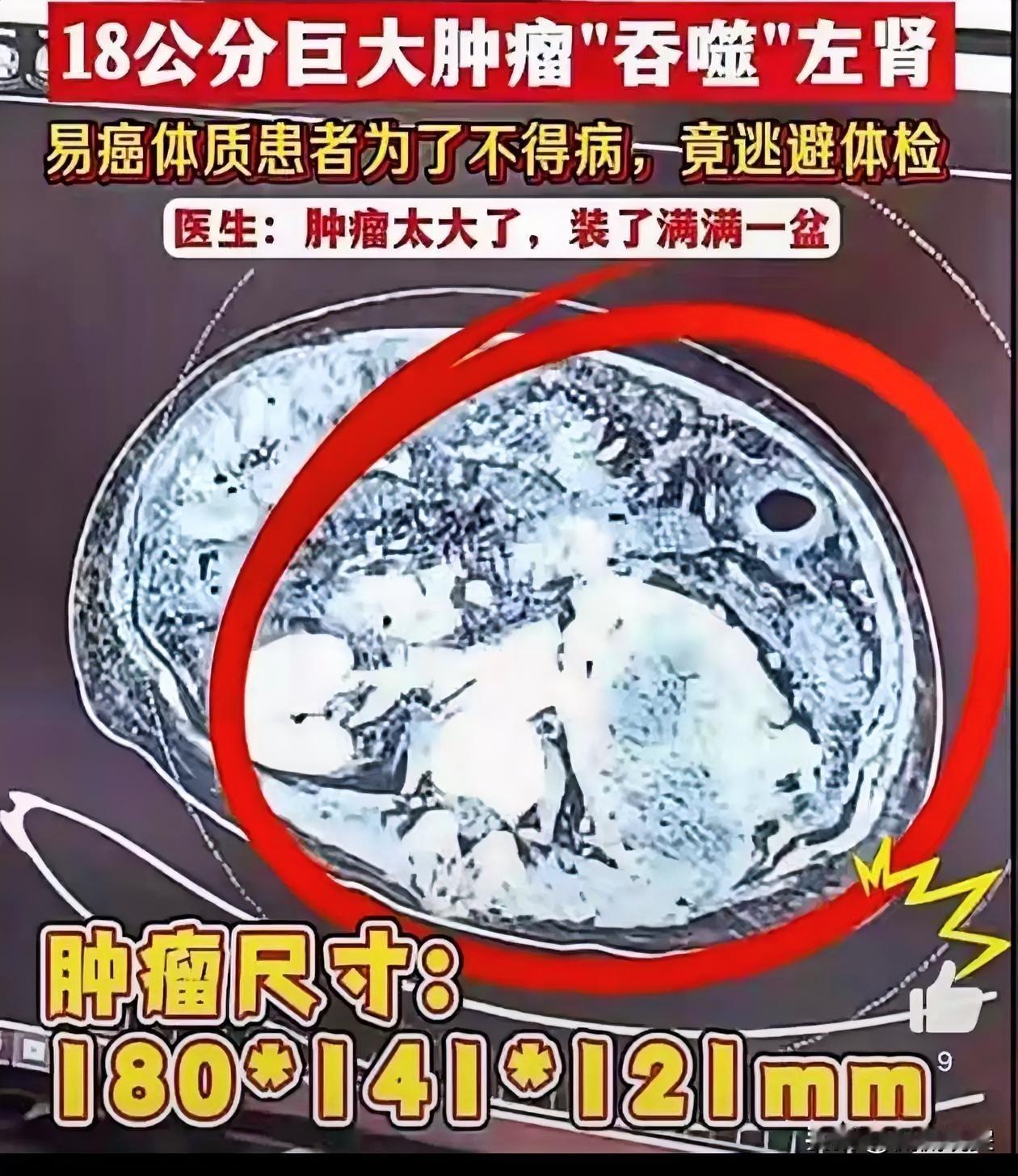 看到女子3次逃避体检左肾长18厘米肿瘤,我总结出了一下几点1. 定期体检不