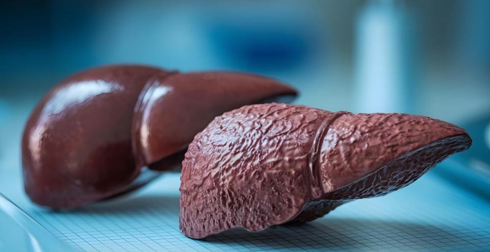 人不会无缘无故患肝硬化！研究发现：得肝硬化的人，离不开这5点肝硬化诊断出来的