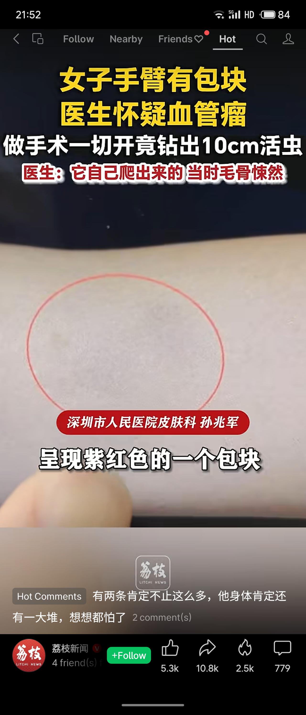 深圳一女子手臂出现紫红色包块，医生初诊怀疑血管瘤。不料手术切开时，竟先后钻出两条
