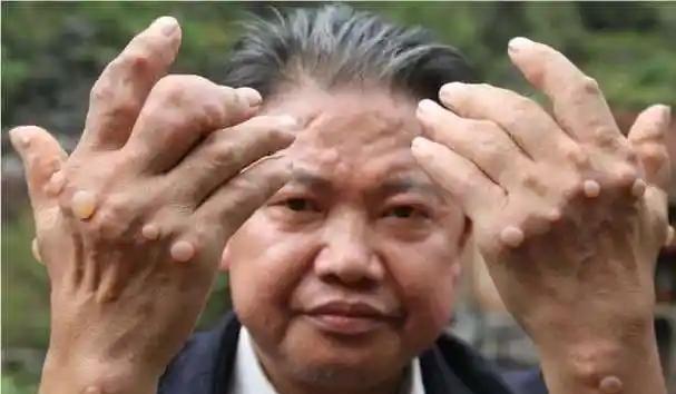 高尿酸的朋友，尤其是那些已经有了痛风经历的朋友，都知道一句话：“尿酸高了，酒得少