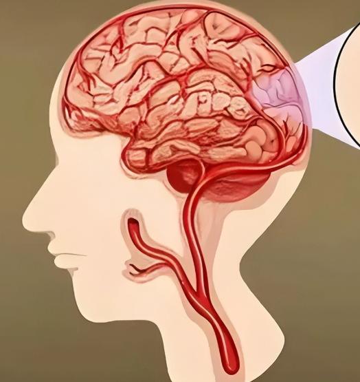 注意！夜间经常出现这些症状，可能是“脑出血”预警，别不当回事很多人以为脑出血