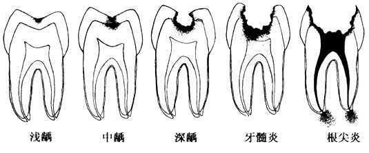 长蛀牙我该怎么办?