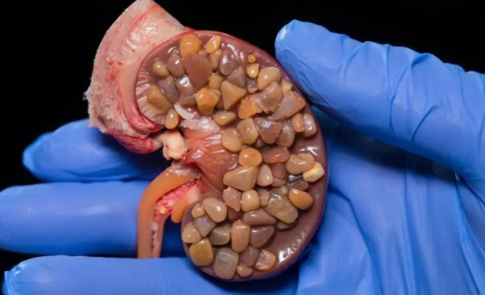 惊悚事实！每天两碗糖水竟让深圳男子体内爬满“石头”，医生：这三类饮品快戒掉！