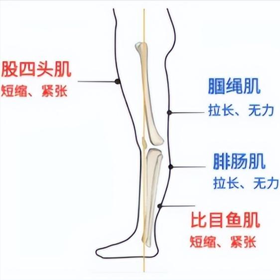 偏瘫后膝过伸，走路姿势难看想改善？先搞明白这三个原因很多偏瘫患者在走路时，会