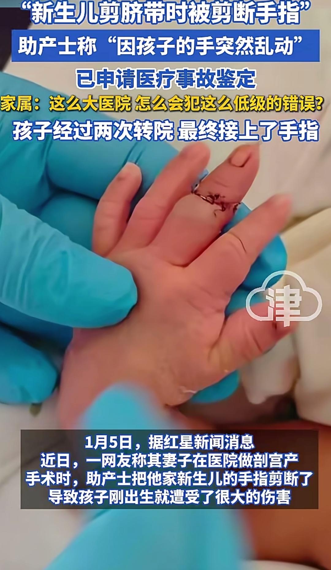 太让人生气了！助产士给新生儿剪脐带时却把婴儿手指剪断，这一幕，换谁来了都压制不住