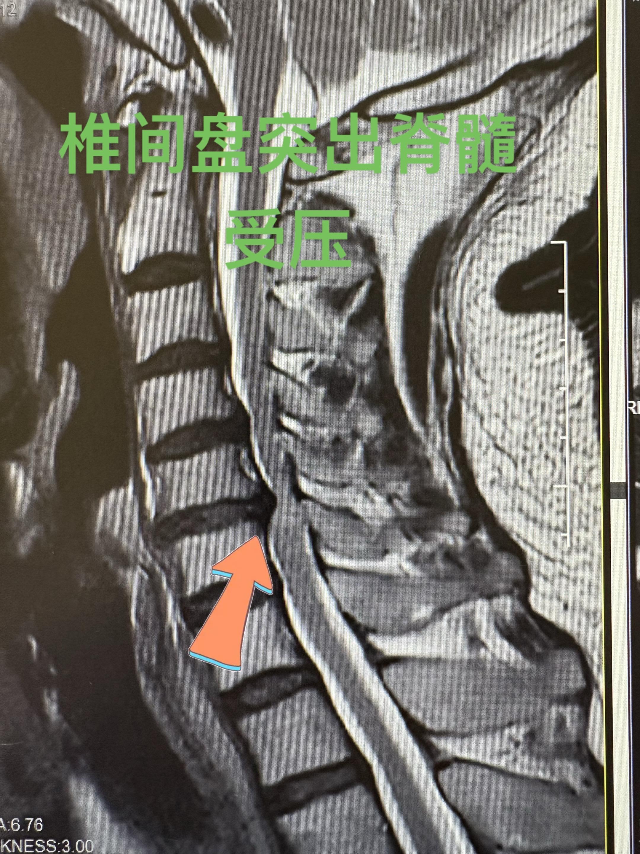 脊髓型颈椎病。外伤之后引起椎间盘突出，四肢麻木，行走有踩棉感，写字变丑...