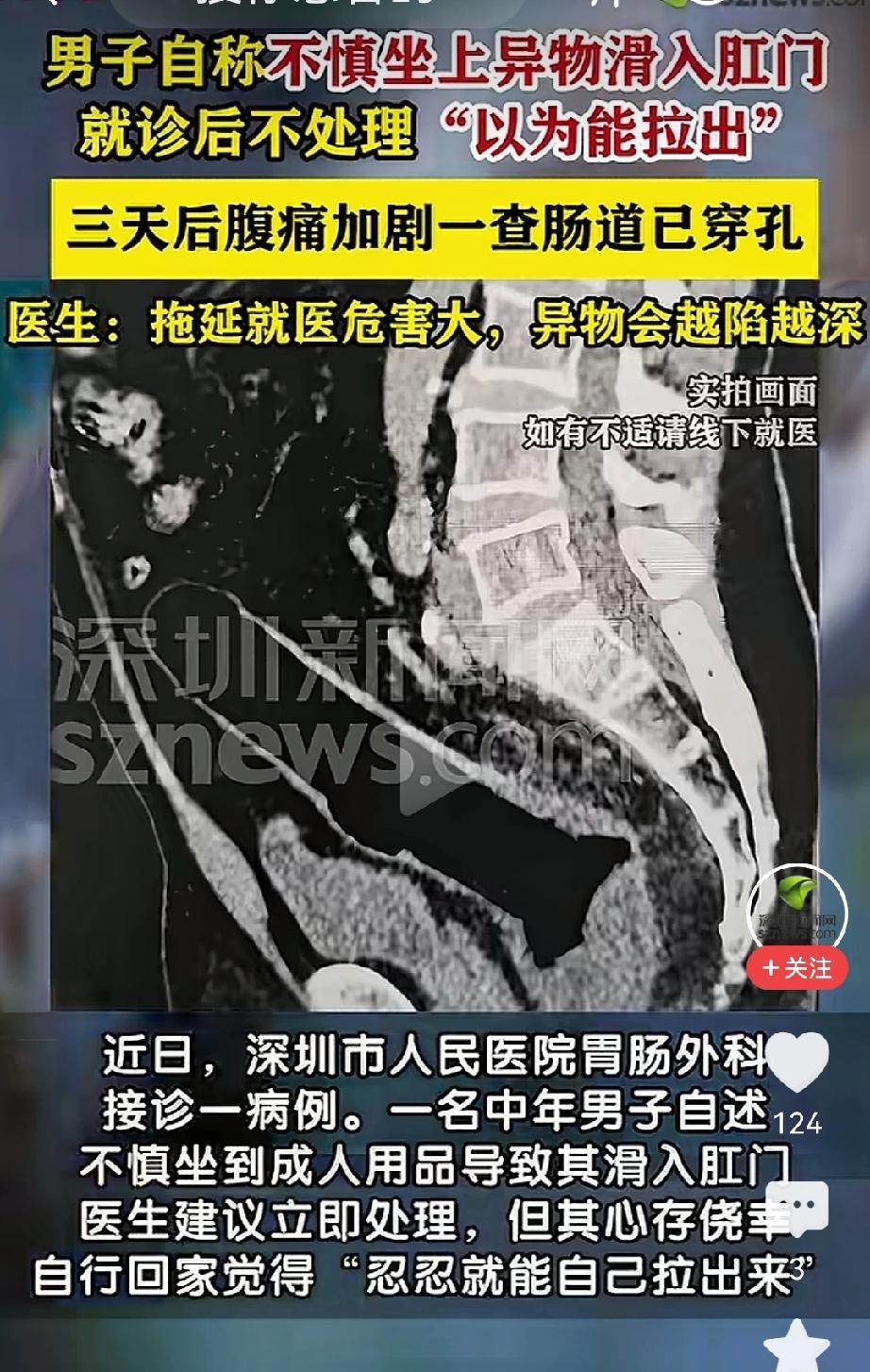 死要面子活受罪！深圳一名男子不慎坐到成人用品，导致异物滑入肛门，医生建议立即处理