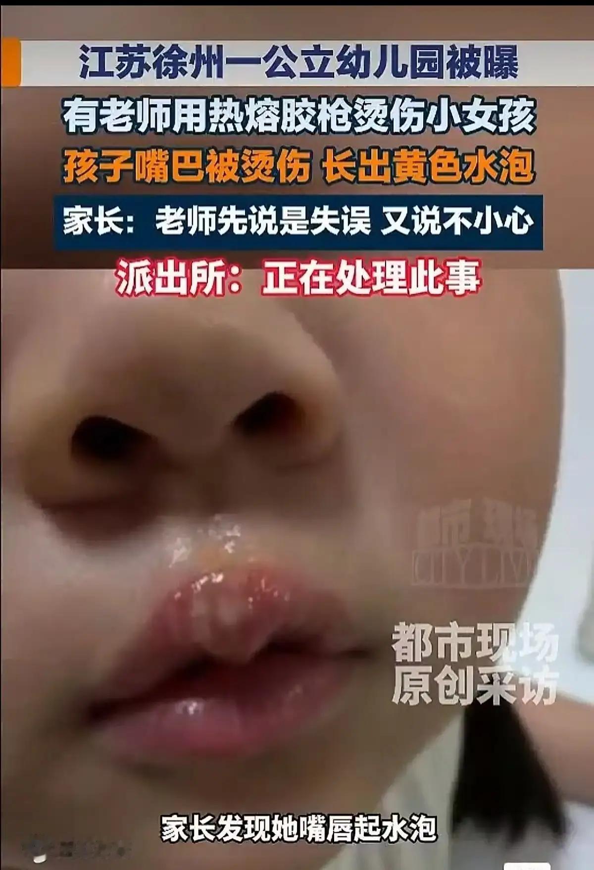 作为同行，说说我对幼师用热熔胶烫幼童的看法一个幼儿园中班的孩子，只有四五岁。被