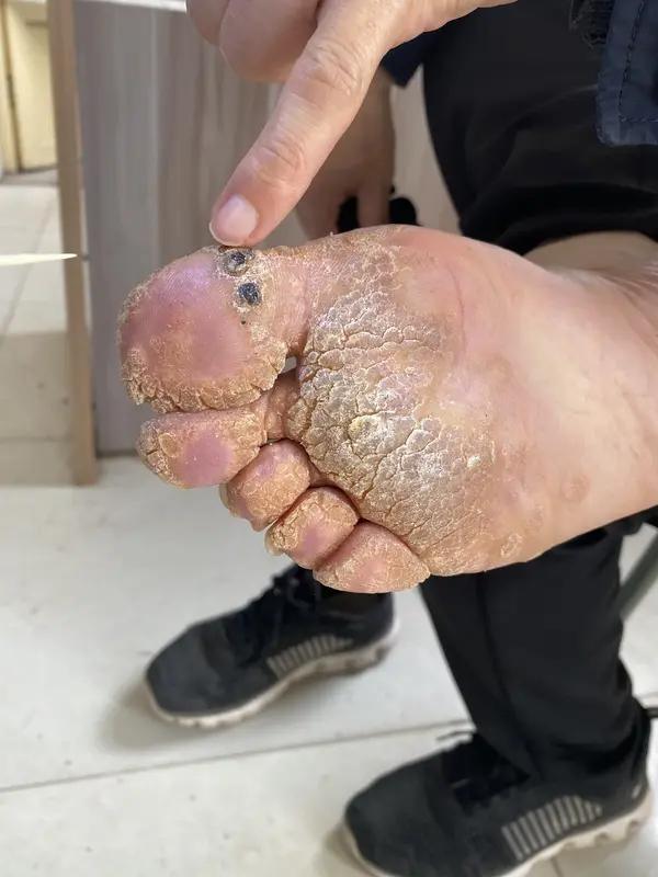 糖尿病患者脚趾溃烂不一定要截肢。糖尿病足是糖尿病常见并发症，脚趾溃烂是其表现之一