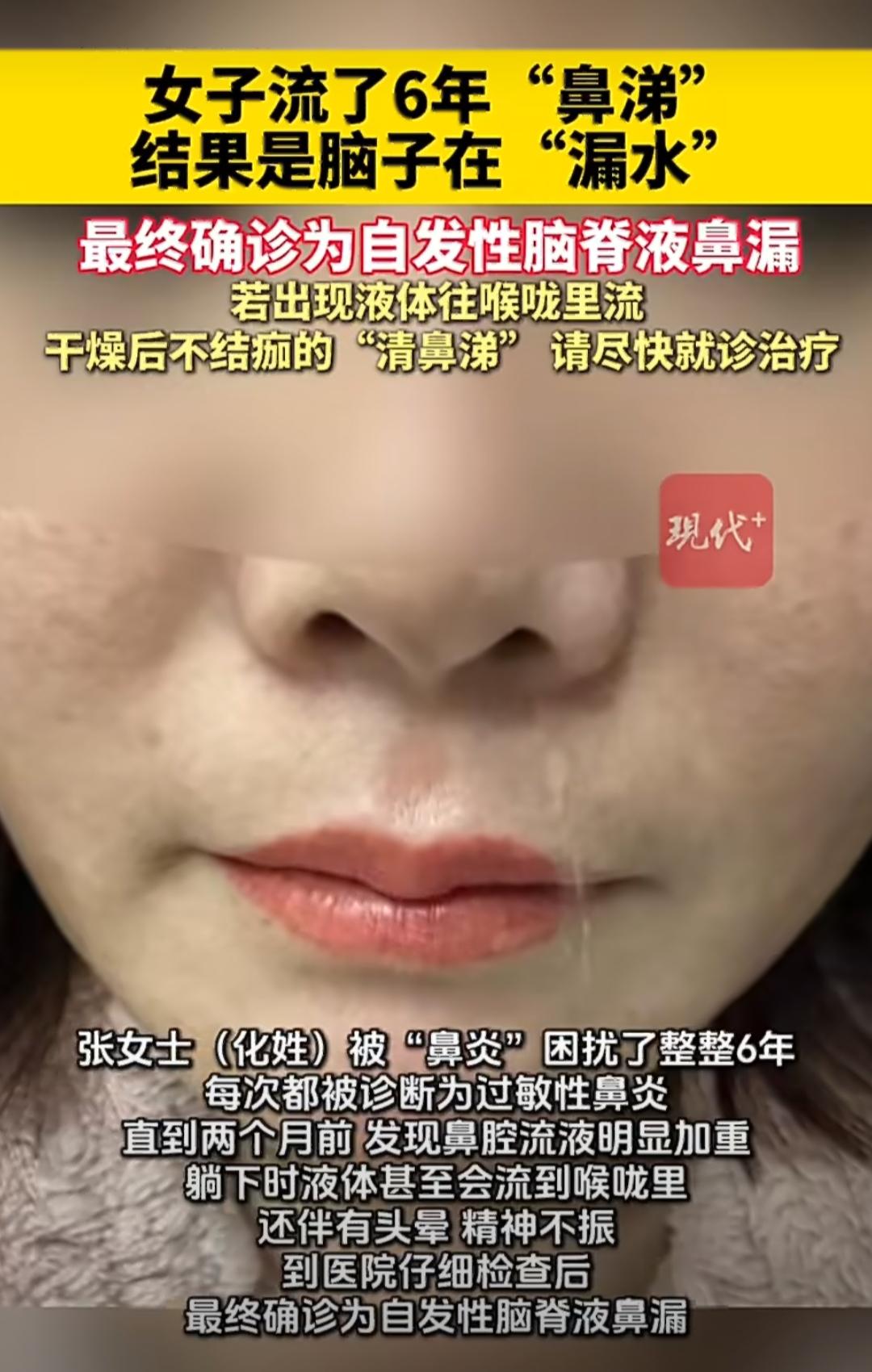 有位张女士，被“鼻炎”折磨了整整6年。她跑了好多次耳鼻喉科，每次都被诊断为过敏性