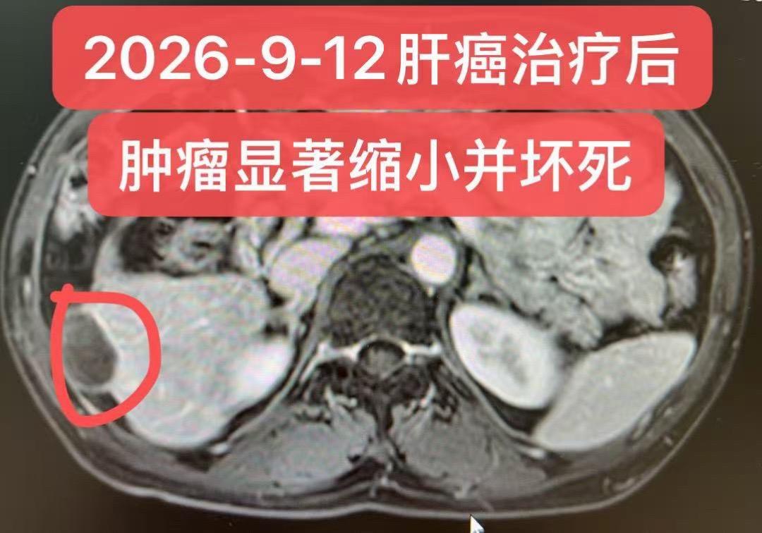 晚期肝癌的综合治疗。患者，男，49岁。2024年5月因颈背痛起病，确诊...