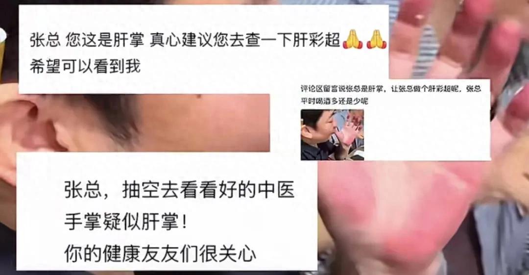 张雪手掌太红被网友催就医 本人回应