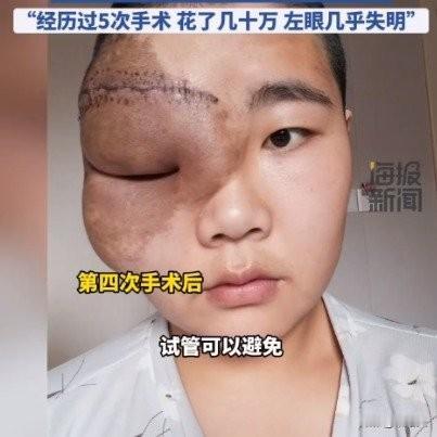 28岁女孩面部长巨瘤：5次手术花几十万，含泪决定不婚不育甘肃定西28岁的田