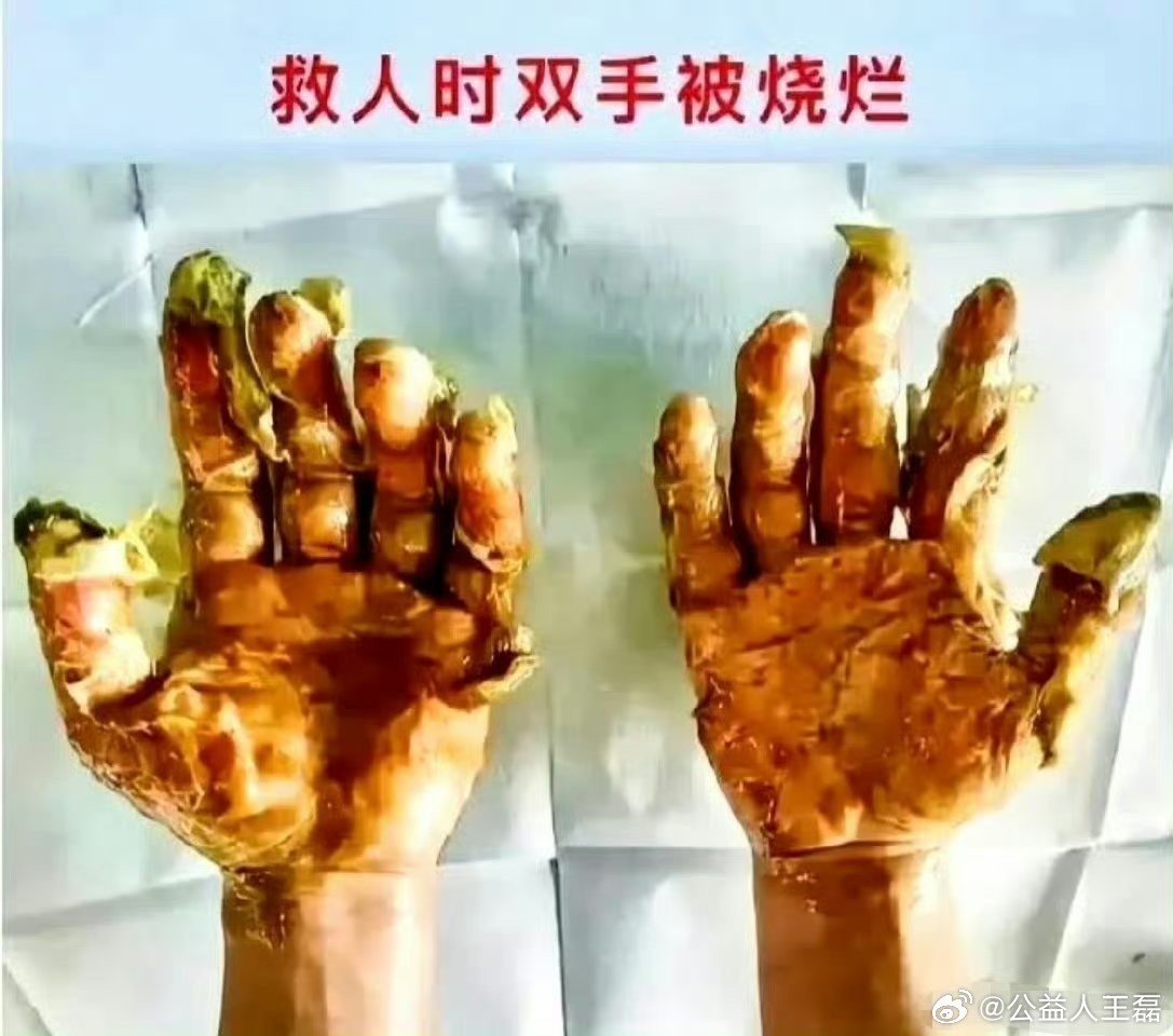 19岁消防员张国炜，在救火现场奋不顾身地救了7个人，自己却被火焰重度烧伤。致敬英雄！[比心]​​​​