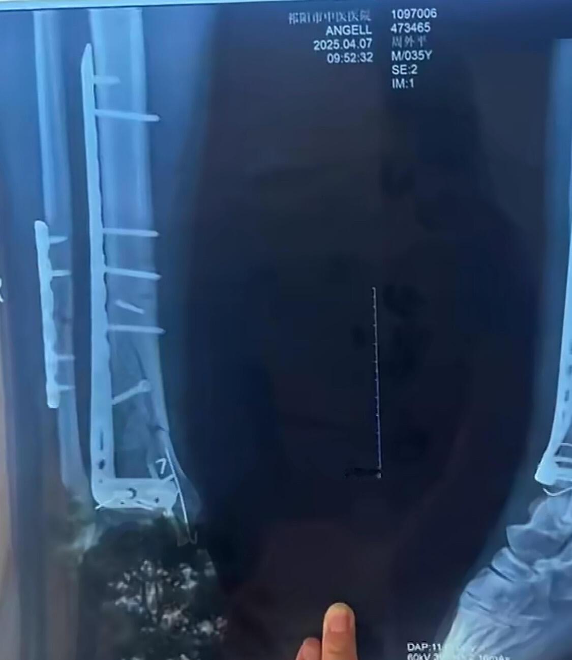 这事儿真让人堵心。湖南永州祁阳市这家中医院，今年3月给两位病人做骨科手术，结