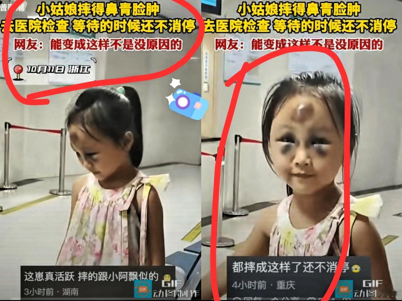 心疼又好笑！有网友在医院看到一个小姑娘，摔的鼻青脸肿的去医院检查，等着的