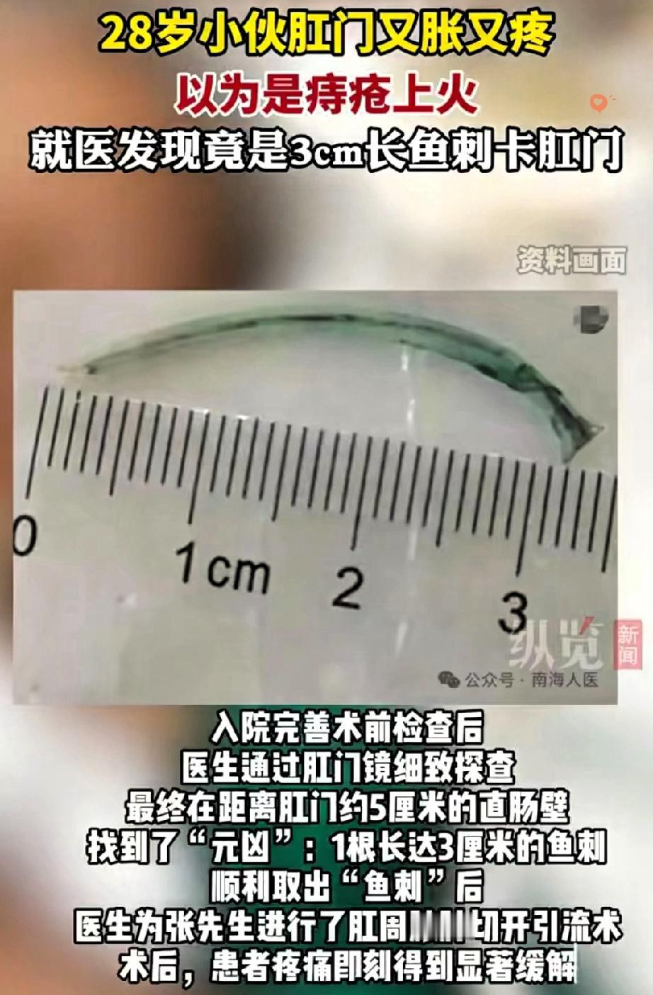 丢人又遭罪！广东男子肛门胀痛难忍，一直当成痔疮乱涂药，结果去医院一查，竟是一根