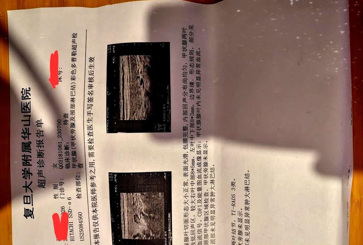去年10月份在青岛青医附院检查甲状腺结节，医生说我甲状腺右叶结节是4a类，内见较