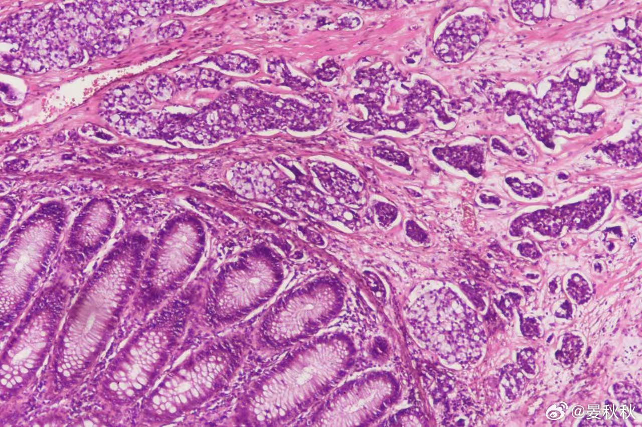 12岁男孩肠癌晚期这是一则令人揪心的消息。河南郑州，一名12岁男孩被确诊为肠癌晚