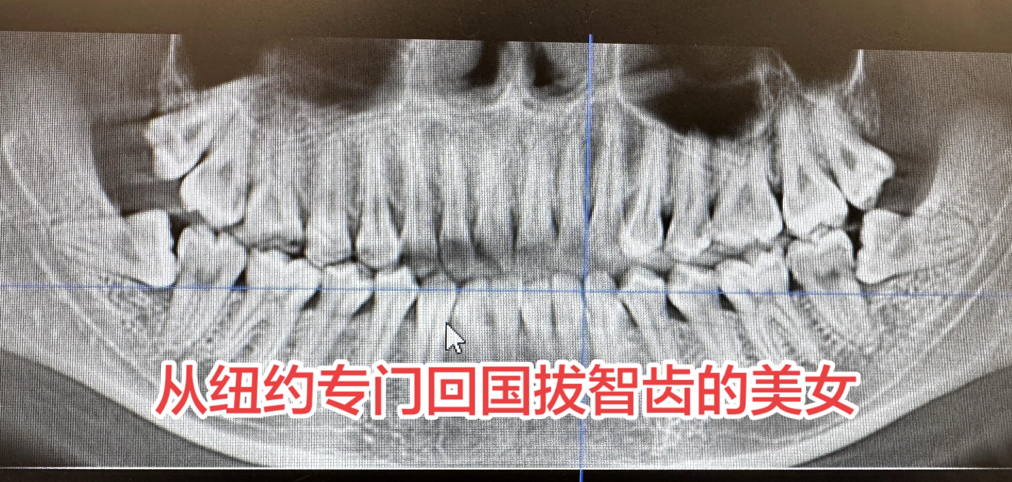 从纽约专门回国拔智齿的美女。从纽约专门回国拔智齿的美女， 因为在那里四...