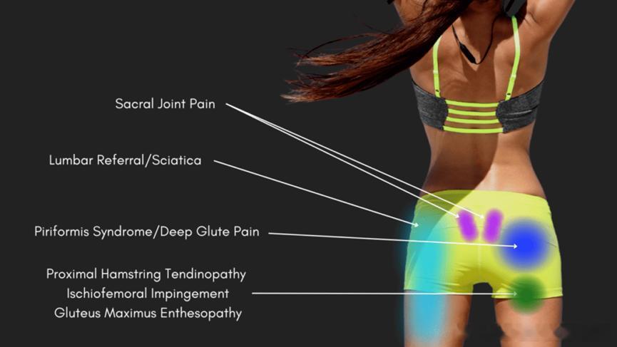 臀部后侧疼痛可能是什么原因给大家整理一波常见原因⚡️骶髂关节疼痛（Sacra