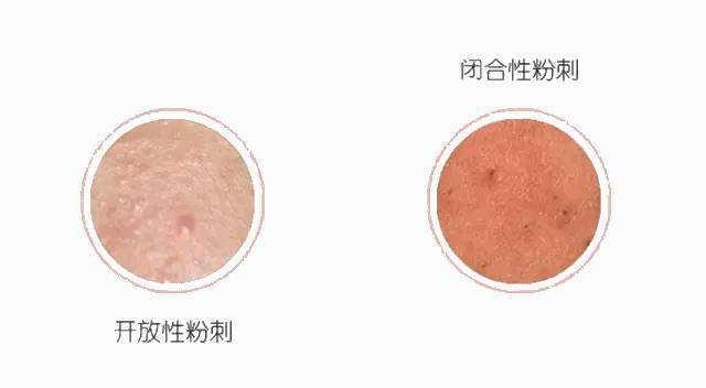 什么是闭合性粉刺? 闭合性粉刺能去除吗?