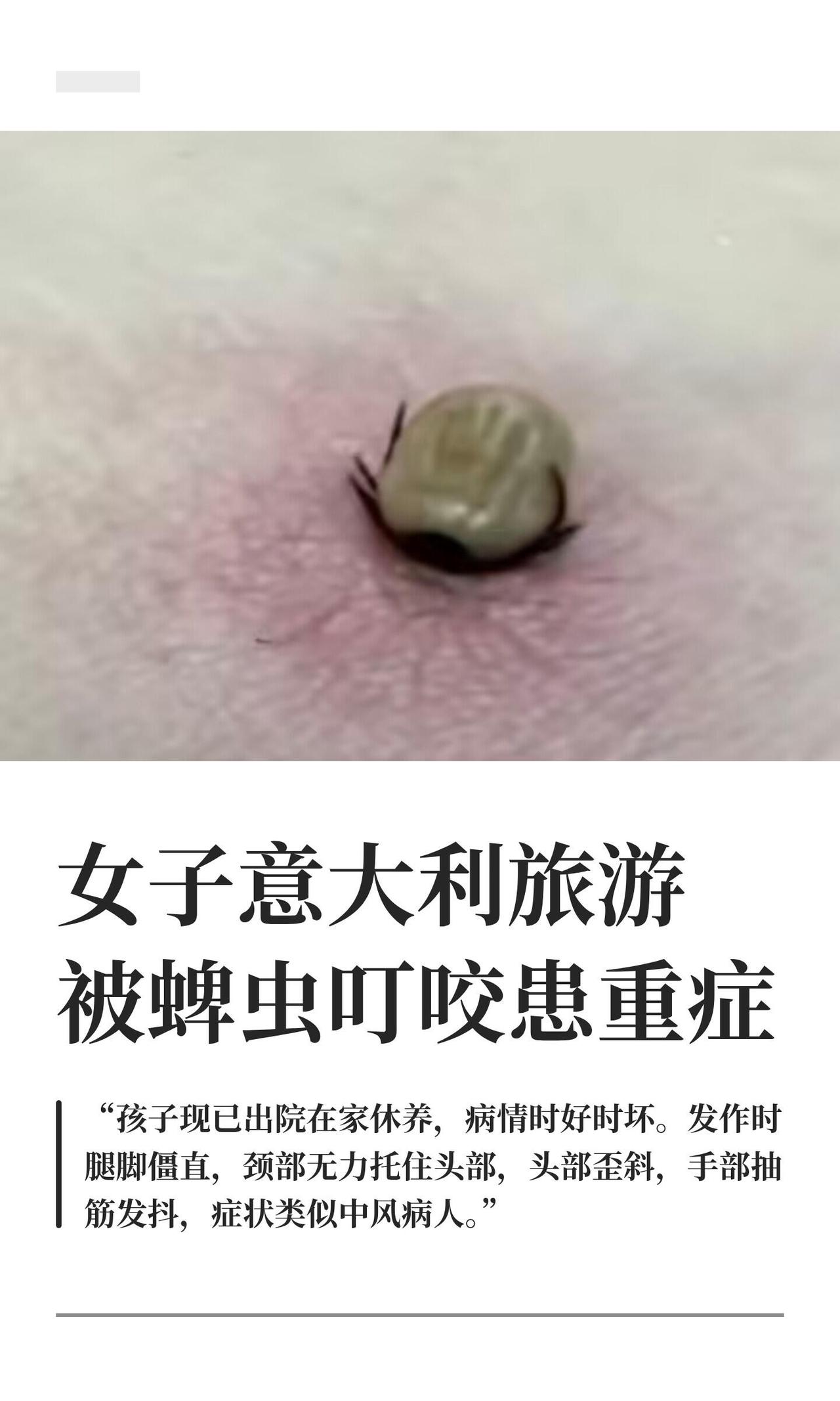 复旦硕士小周，去意大利高山草地玩，被蜱虫叮了都没发觉。8月5号咬的，回国五六天才