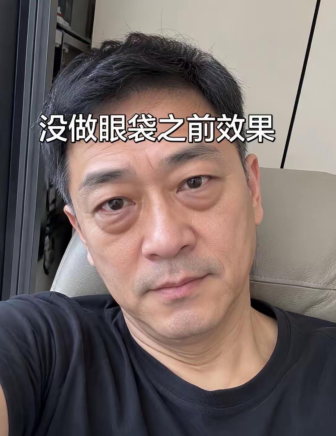 效果很好[赞]这种小整形没什么风险，我也做了眼袋，自信多了[捂脸哭]
