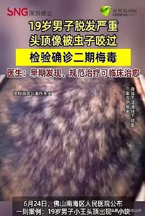 广东佛山那个19岁的高中男生，因为头顶几块像被老鼠啃过的脱发去看皮肤科，结果被医