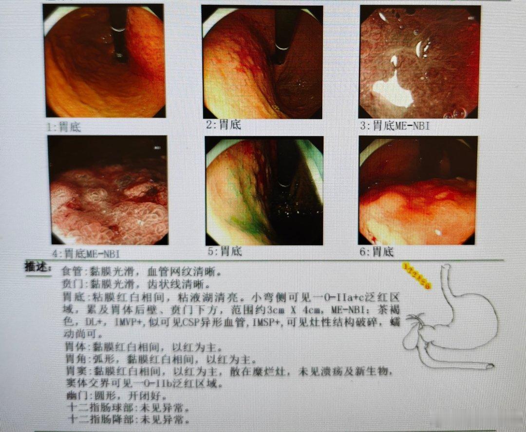 还好消化道早癌，超声内镜搞得早，AI这冲击还是蛮大的，以后真只有操作类，手术类，