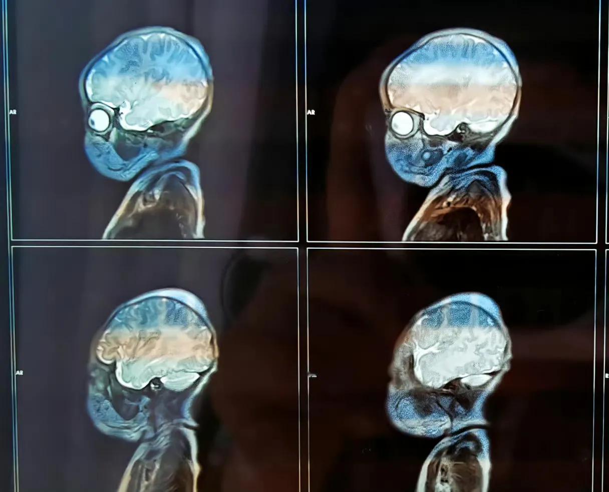 第一次看到小婴儿的医学影像,为啥小婴儿连拍片子都这么可爱。小婴儿的核磁共振全