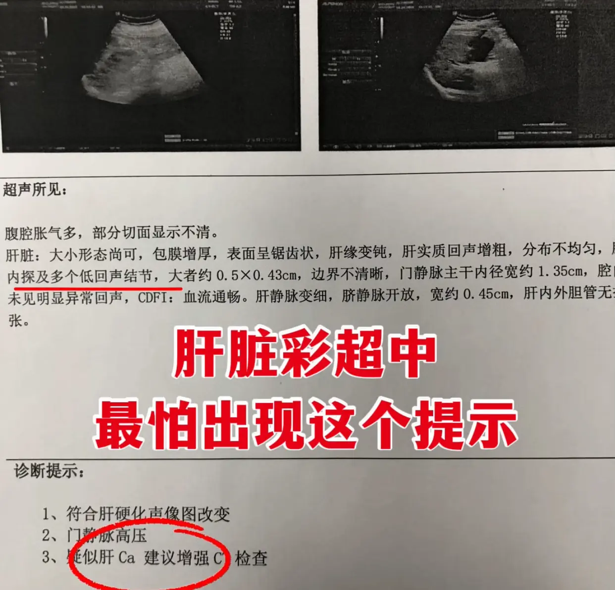 今天接诊一位 43 岁年轻患者，整个人身形消瘦、脸色发黄，一看肝脏就出...