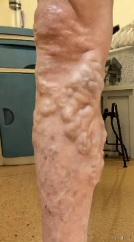 腿上凸的小蚯蚓千万别硬扛！大爷拖十几年，取出40厘米长血栓很多人腿上长满弯弯曲