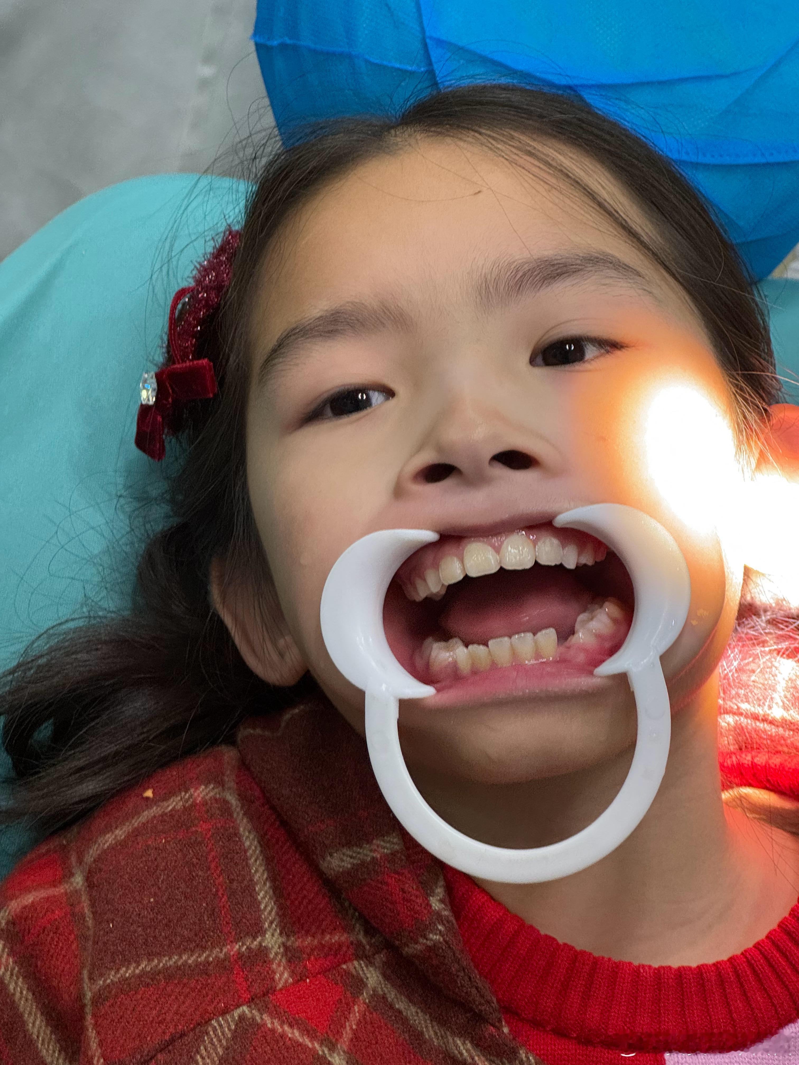 安姐因为有鼻炎有点腺样体面容上牙有点骨性突出去年配了牙套后效果很好很快就压回去了