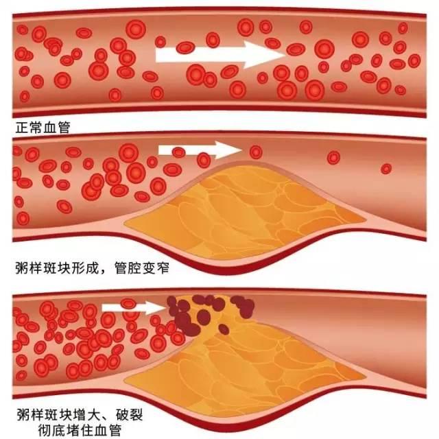 血管堵不堵，看这四个地方就能知道，早知道大家早省心超过40岁的朋友，身体有这