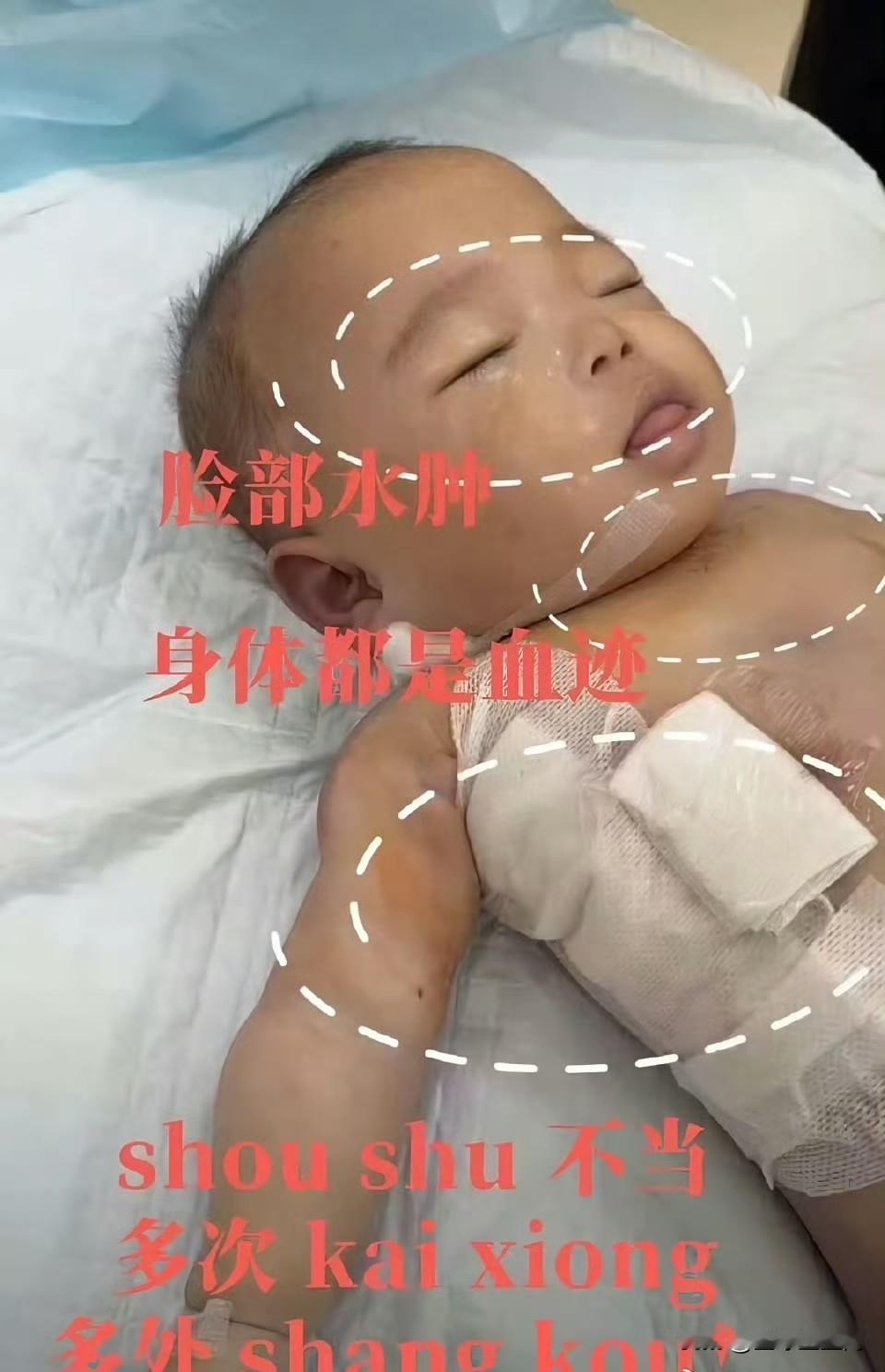 小洛熙爸爸称已拿到尸检报告！尸检报告揭开残酷真相：无对应病症却遭手术，6.5cm