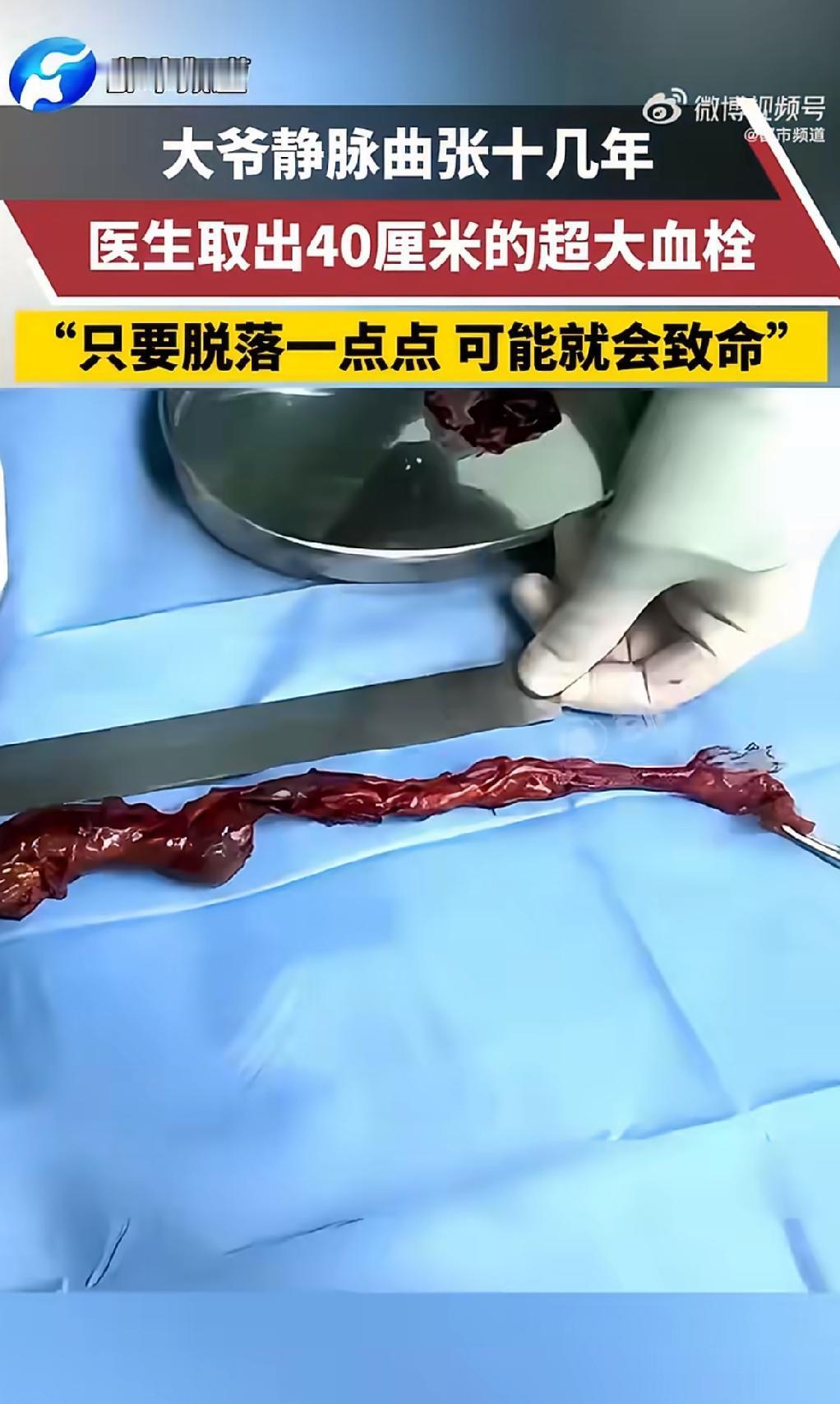“这也太吓人了！”7月1日报道，北京，一大爷患了静脉曲张，他觉得自己没什么事儿，